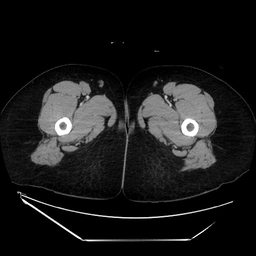 Acute uncomplicated appendicitis (Radiopaedia 73704-84499 Axial C+ portal venous phase 190).jpg