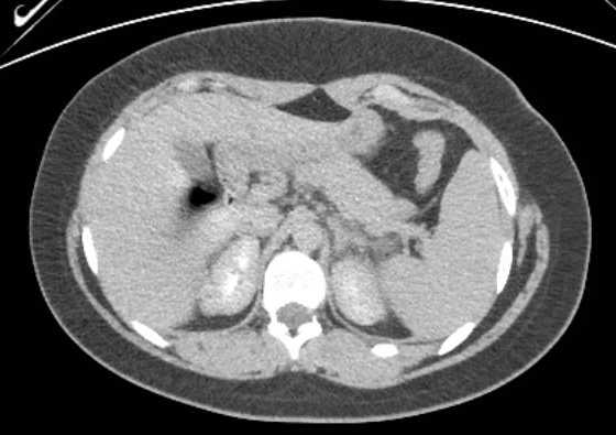 Acute unilateral nonhemorrhagic adrenal infarction (Radiopaedia 67560-76957 Axial renal excretory phase 29).jpg