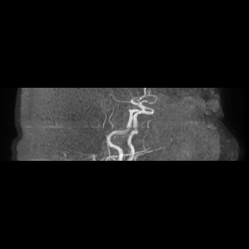 File:Acute vertebrobasilar ischemic infarction (Radiopaedia 25220-25474 Axial MRA 19).jpg