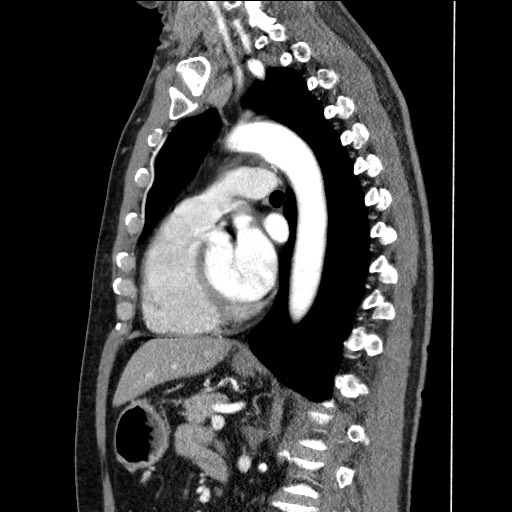 Adenocarcinoma of the lung (Radiopaedia 59871-67325 Sagittal C+ arterial phase 60).jpg