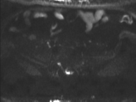 Adenocarcioma of rectum- T1 lesion (Radiopaedia 36921-38546 Axial DWI 30).png