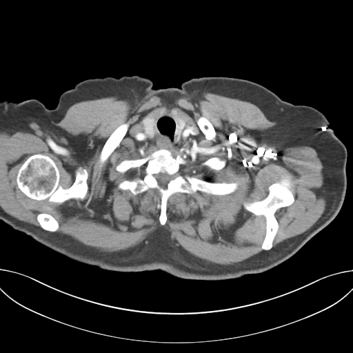 Adenocarcioma of rectum- T1 lesion (Radiopaedia 36921-38547 Axial C+ arterial phase 6).png