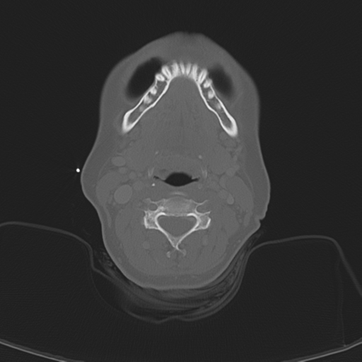 File:Adenoid cystic tumor of palate (Radiopaedia 46980-51518 Axial bone window 41).png