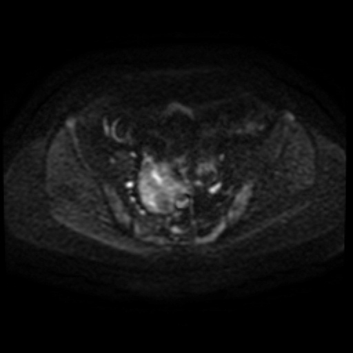 Adenoma malignum of cervix (Radiopaedia 66441-75705 Axial DWI 81).jpg