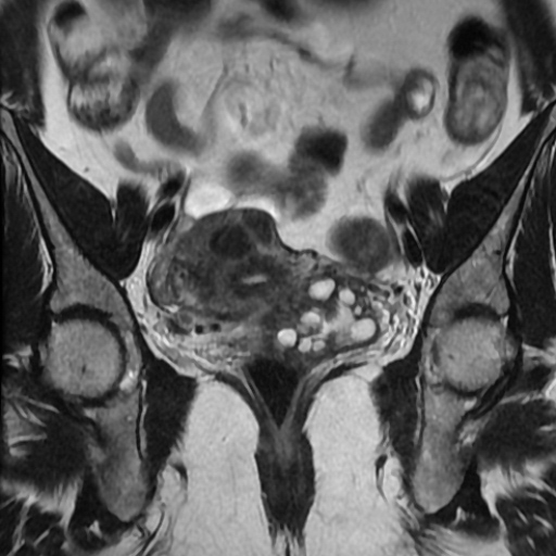 File:Adenoma malignum of cervix (Radiopaedia 66441-75705 Coronal T2 8).jpg