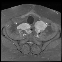 File:Adenomyosis within a didelphys uterus (Radiopaedia 70175-80215 Axial T1 C+ fat sat 18).jpg