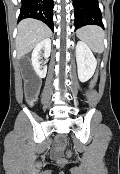 Adhesional small bowel obstruction (Radiopaedia 52107-57980 Coronal C+ portal venous phase 60).jpg