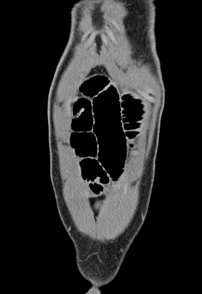 Adhesional small bowel obstruction (Radiopaedia 52107-57980 Coronal C+ portal venous phase 7).jpg
