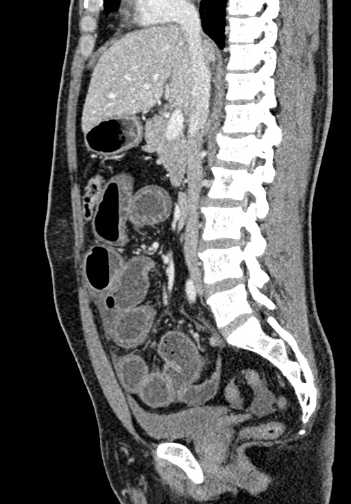 Adhesional small bowel obstruction (Radiopaedia 58900-66131 Sagittal C+ portal venous phase 114).jpg