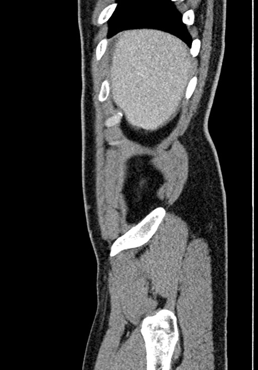 Adhesional small bowel obstruction (Radiopaedia 58900-66131 Sagittal C+ portal venous phase 27).jpg