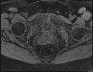 File:Adnexal multilocular cyst (O-RADS US 3. O-RADS MRI 3) (Radiopaedia 87426-103754 Axial 200).jpeg