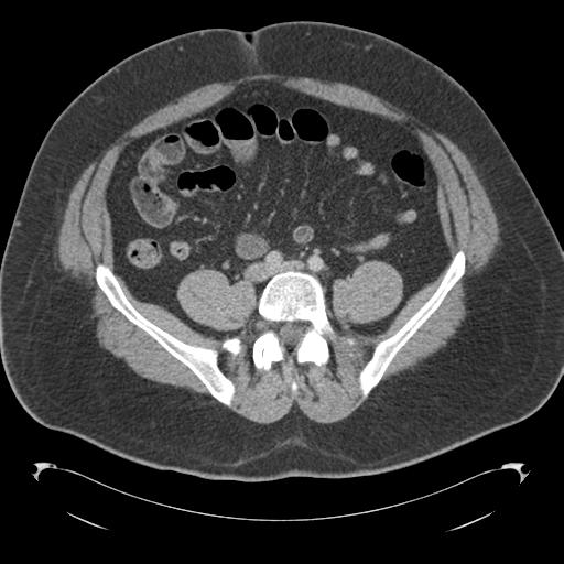 File:Adrenal cyst (Radiopaedia 45625-49776 Axial C+ portal venous phase 65).png