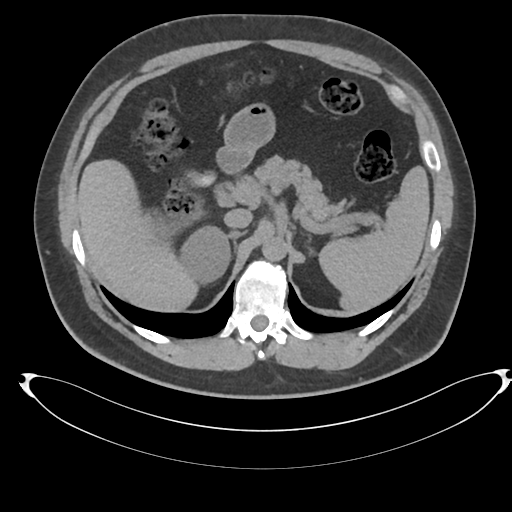File:Adrenal cyst (Radiopaedia 45625-49778 Axial non-contrast 29).png