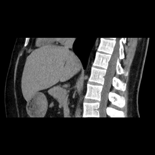 Adrenal gland trauma (Radiopaedia 81351-95079 Sagittal non-contrast 50).jpg