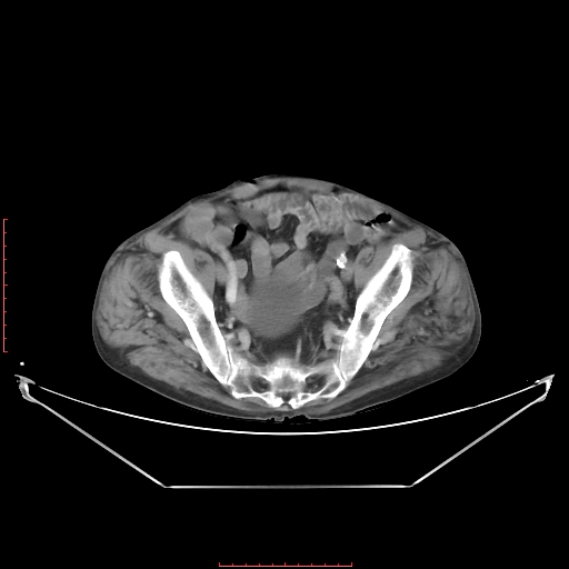 Adrenal hemangioma (Radiopaedia 68923-78668 Axial C+ portal venous phase 59).jpg