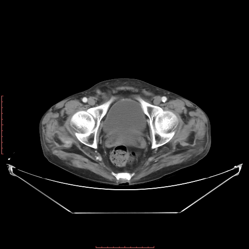 File:Adrenal hemangioma (Radiopaedia 68923-78668 Axial C+ portal venous phase 66).jpg