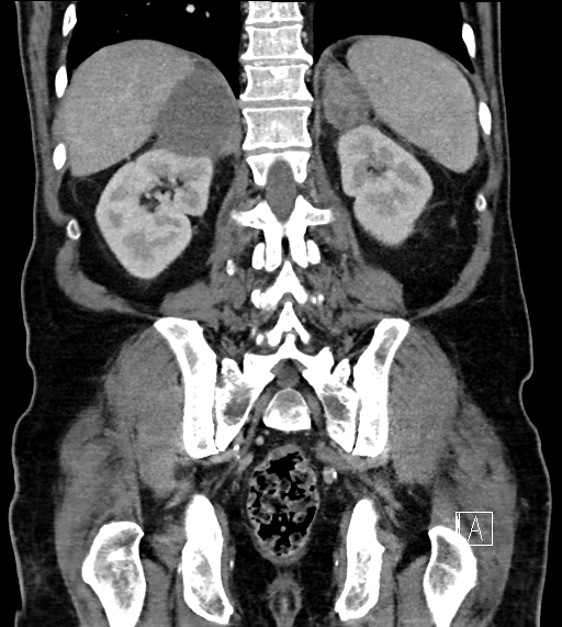 Adrenal lymphoma (Radiopaedia 73730-84529 Coronal C+ portal venous phase 60).jpg