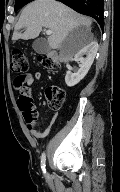 Adrenal lymphoma (Radiopaedia 73730-84529 Sagittal C+ portal venous phase 36).jpg
