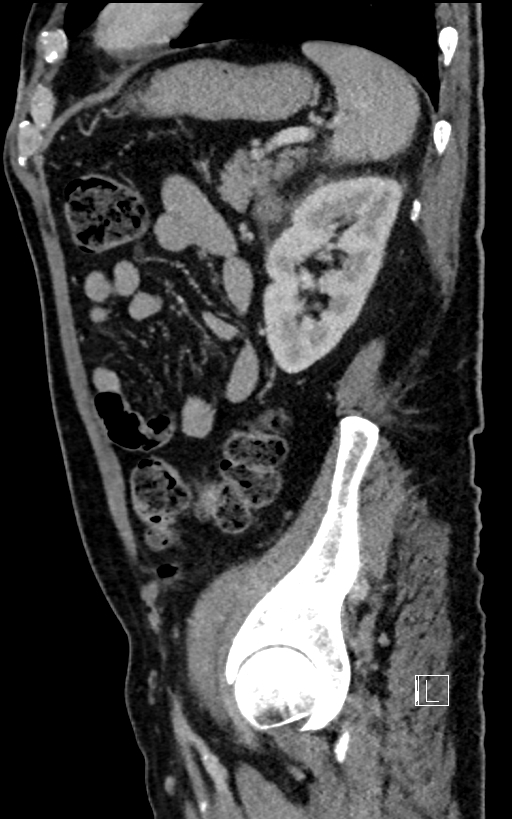 Adrenal lymphoma (Radiopaedia 73730-84529 Sagittal C+ portal venous phase 83).jpg