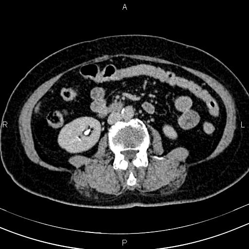 Adrenal myelolipoma (Radiopaedia 82742-96986 Axial renal excretory phase 80).jpg