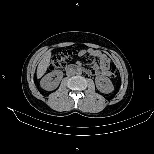 Adrenal myelolipoma (Radiopaedia 87794-104246 Axial non-contrast 51).jpg