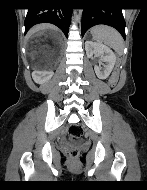 Adrenal myelolipoma - bilateral (Radiopaedia 74805-85810 Coronal C+ portal venous phase 110).jpg
