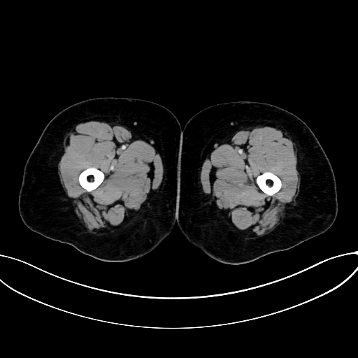 File:Adrenocortical carcinoma (Radiopaedia 87281-103569 Axial C+ portal venous phase 103).jpg
