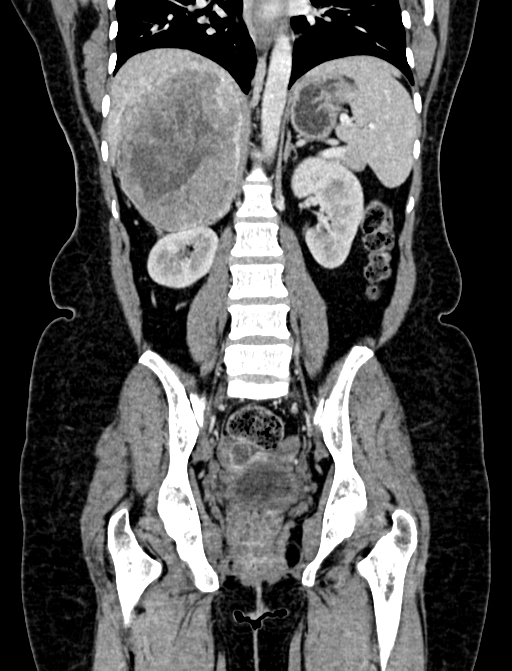 Adrenocortical carcinoma (Radiopaedia 87281-103569 Coronal C+ portal venous phase 76).jpg
