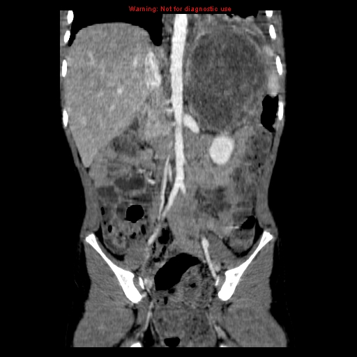 File:Adrenocortical carcinoma (Radiopaedia 9449-10131 Coronal C+ portal venous phase 8).jpg