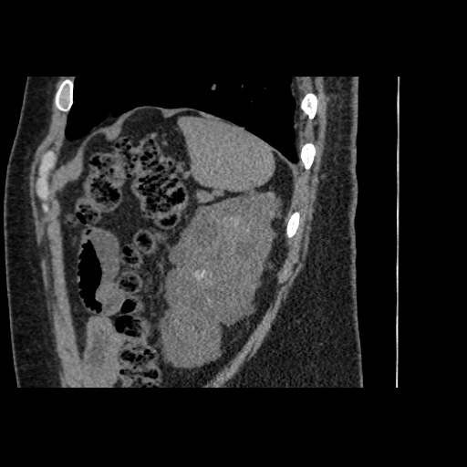 Adult polycystic kidney disease (Radiopaedia 59075-66368 Sagittal non-contrast 77).jpg