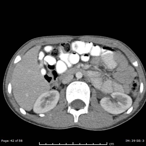 Agenesis of the gallbladder (Radiopaedia 55454-61905 B 42).jpg