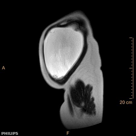 Aggressive angiomyxoma (Radiopaedia 73343-84093 Sagittal T2 5).jpg