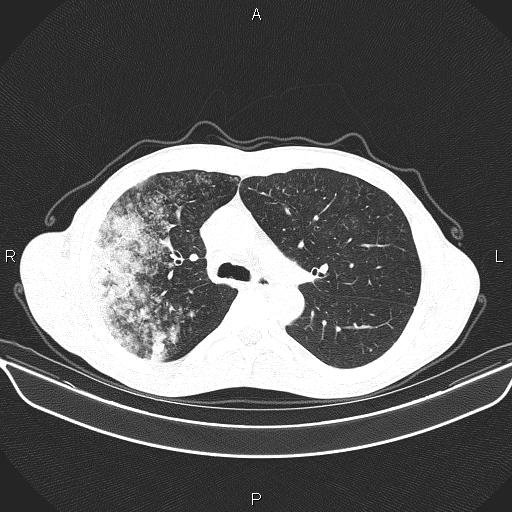Air bronchogram in pneumonia (Radiopaedia 85719-101512 Axial lung window 26).jpg