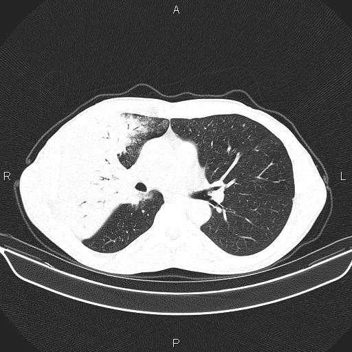 Air bronchogram in pneumonia (Radiopaedia 85719-101512 Axial lung window 32).jpg