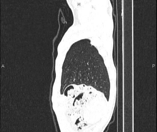 Air bronchogram in pneumonia (Radiopaedia 85719-101512 Sagittal lung window 94).jpg