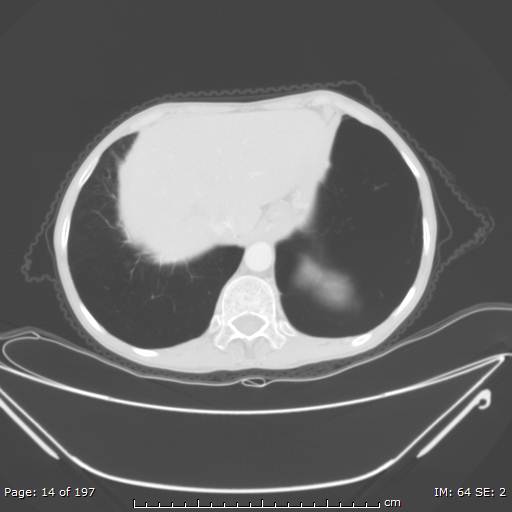 Alpha-1-antitrypsin deficiency (Radiopaedia 50561-55987 Axial lung window 7).jpg