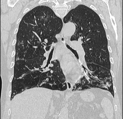 Alpha-1-antitrypsin deficiency (Radiopaedia 72058-82557 Coronal lung window 49).jpg
