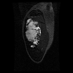 Alveolar soft part sarcoma (Radiopaedia 64501-73678 D 117).jpg