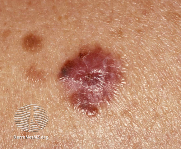 File:Amelanotic melanoma 17 of 125 (DermNet NZ amelanotic-melanoma-17-of-125).jpg
