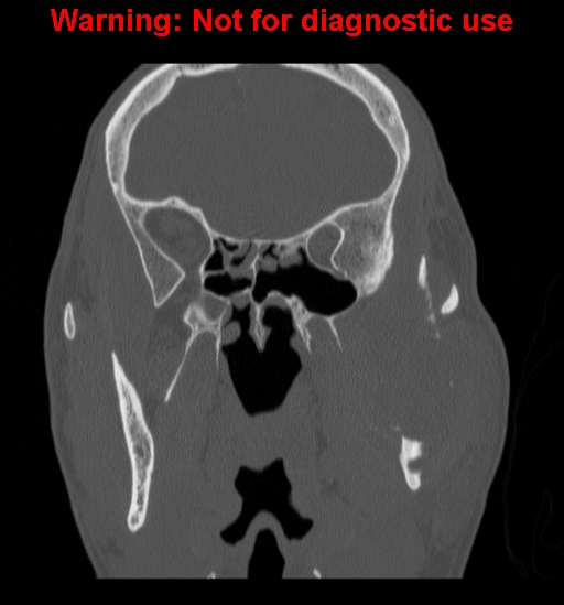File:Ameloblastoma (Radiopaedia 13276-13280 Coronal non-contrast 15).jpg