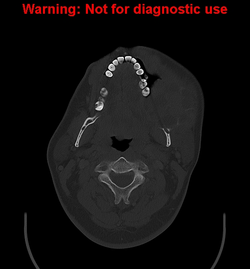 Ameloblastoma (Radiopaedia 33126-34164 Axial bone window 11).jpg
