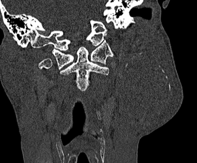 Ameloblastoma (Radiopaedia 51921-57766 Coronal bone window 214).jpg