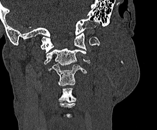 Ameloblastoma (Radiopaedia 51921-57766 Coronal bone window 233).jpg