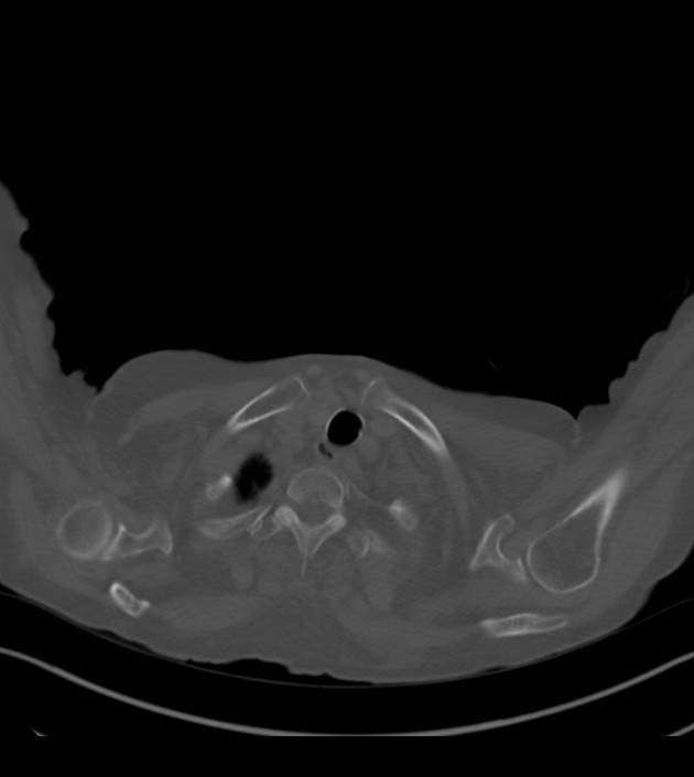 Amiodarone deposition in the liver (Radiopaedia 77587-89780 Axial bone window 6).jpg