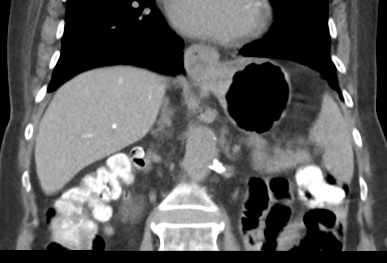 Ampullary adenocarcinoma (Radiopaedia 34013-35241 Coronal 28).png