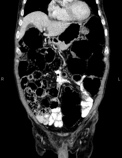 Ampullary adenocarcinoma (Radiopaedia 86093-102032 C 18).jpg