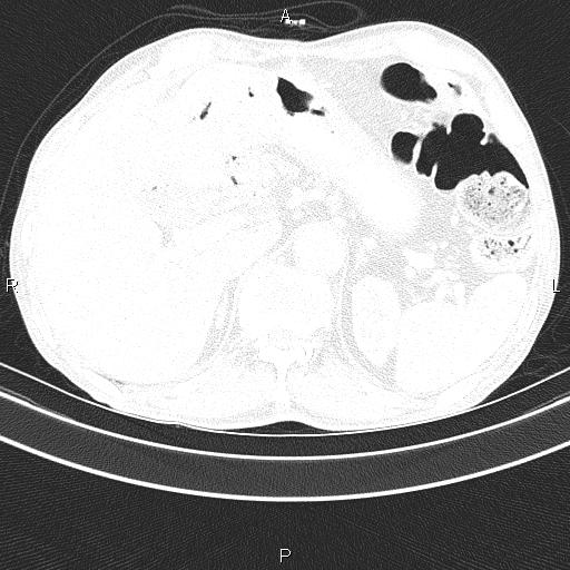 File:Ampullary adenocarcinoma (Radiopaedia 86093-102033 Axial lung window 55).jpg