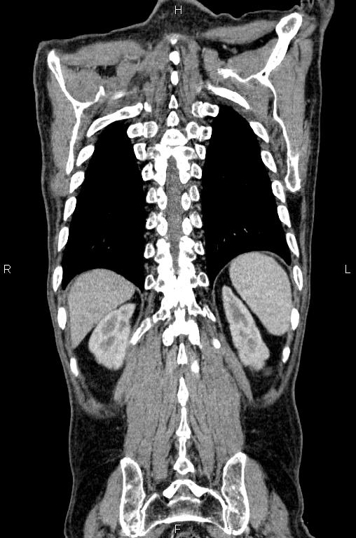 Ampullary adenocarcinoma (Radiopaedia 86093-102033 D 52).jpg