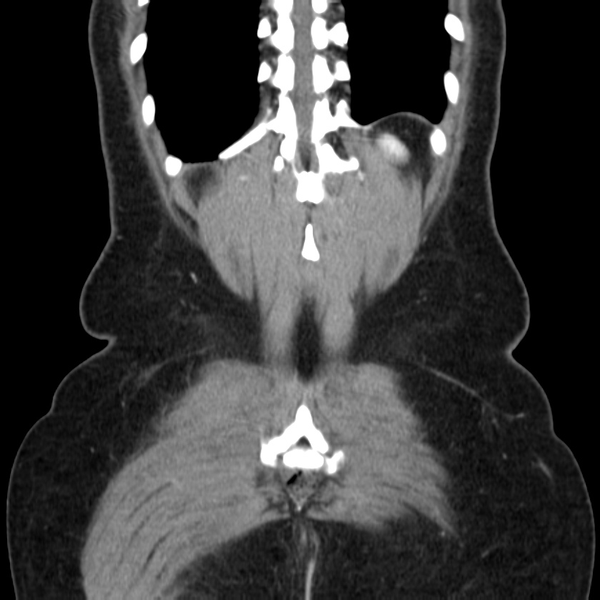 Ampullary tumor (Radiopaedia 22787-22816 E 47).jpg