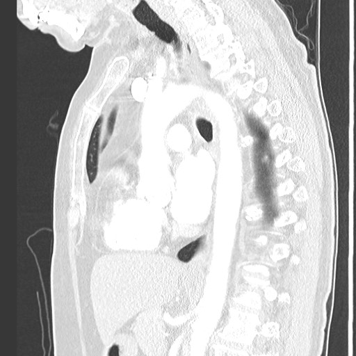Amyloidosis - bronchial and diffuse nodular pulmonary involvement (Radiopaedia 60156-67745 Sagittal lung window 49).jpg